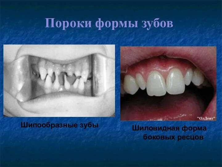 Пороки формы зубов Шипообразные зубы Шиловидная форма боковых ресцов