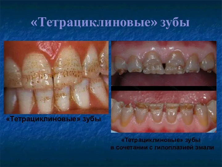 «Тетрациклиновые» зубы «Тетрациклиновые» зубы «Тетрациклиновые» зубы в сочетании с гипоплазией эмали