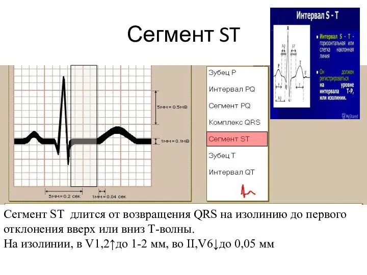 Сегмент ST Сегмент ST длится от возвращения QRS на изолинию