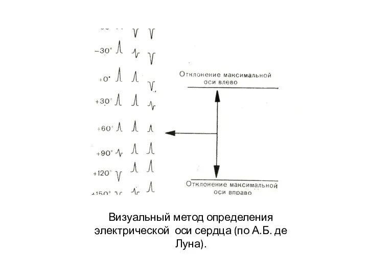 Визуальный метод определения электрической оси сердца (по А.Б. де Луна).