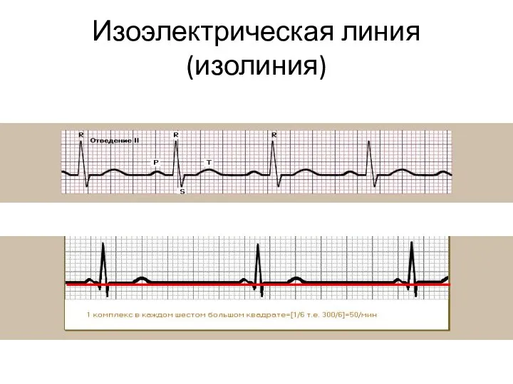 Изоэлектрическая линия (изолиния)