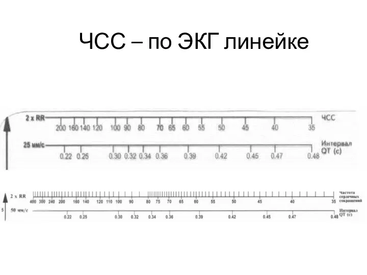 ЧСС – по ЭКГ линейке