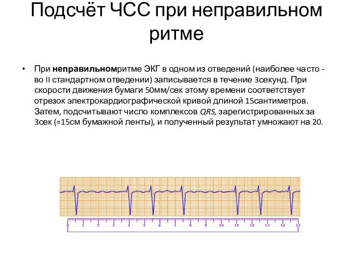 Подсчёт ЧСС при неправильном ритме При неправильномритме ЭКГ в одном