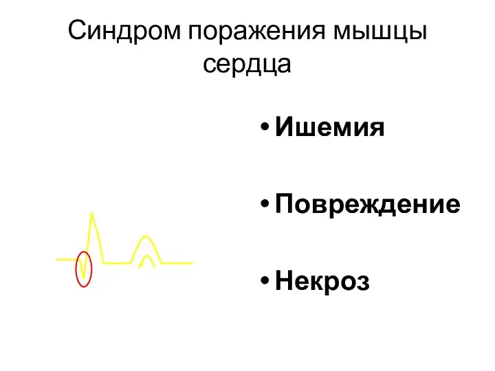 Ишемия Повреждение Некроз Синдром поражения мышцы сердца