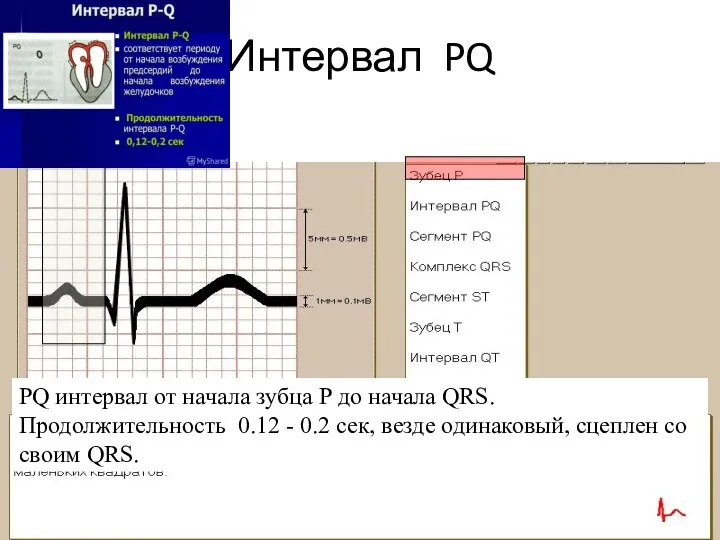 Интервал PQ PQ интервал от начала зубца Р до начала QRS. Продолжительность 0.12