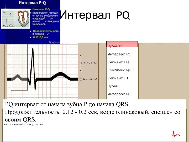 Интервал PQ PQ интервал от начала зубца Р до начала