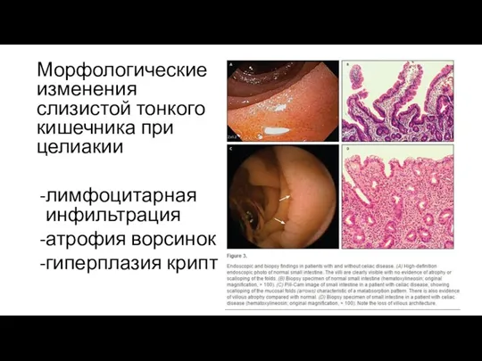 Морфологические изменения слизистой тонкого кишечника при целиакии лимфоцитарная инфильтрация атрофия ворсинок гиперплазия крипт