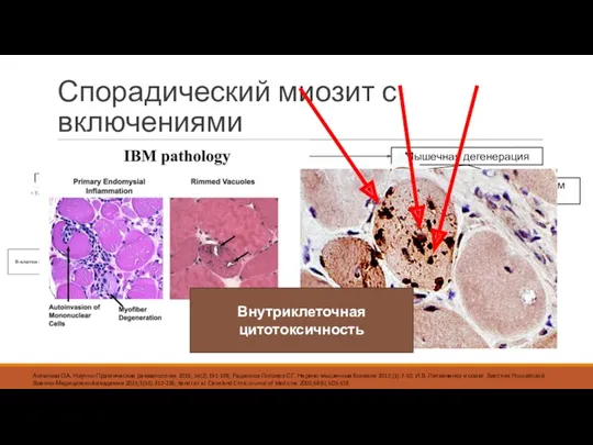 Спорадический миозит с включениями Хроническое воспаление Мышечная дегенерация Амилоид-β42 Белки