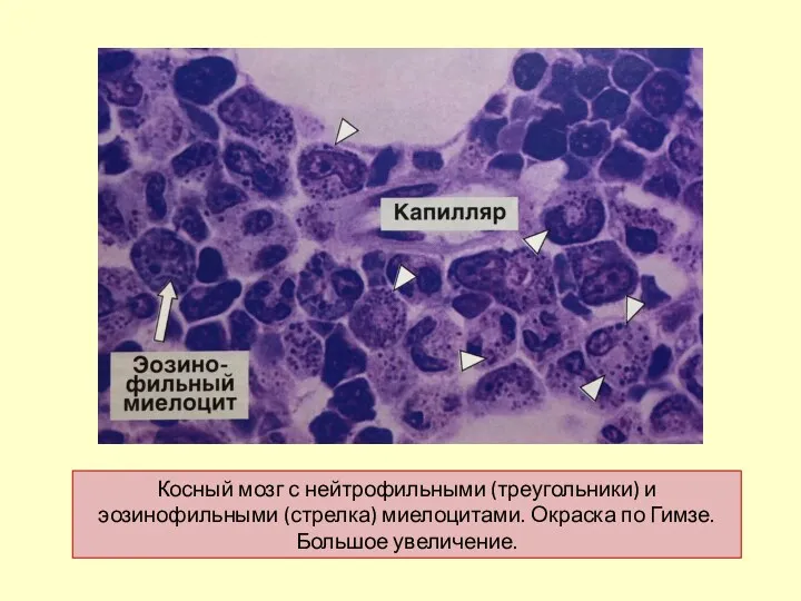 Косный мозг с нейтрофильными (треугольники) и эозинофильными (стрелка) миелоцитами. Окраска по Гимзе. Большое увеличение.