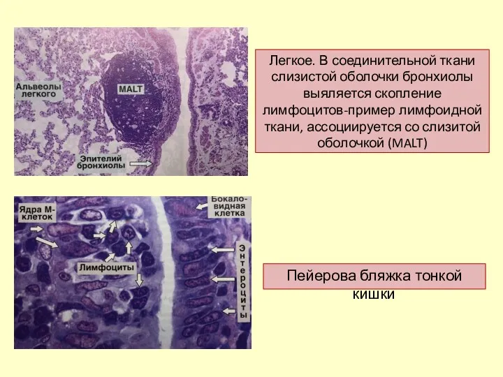 Легкое. В соединительной ткани слизистой оболочки бронхиолы выяляется скопление лимфоцитов-пример лимфоидной ткани, ассоциируется