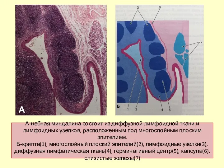 А-небная миндалина состоит из диффузной лимфоидной ткани и лимфоидных узелков, расположенным под многослойным