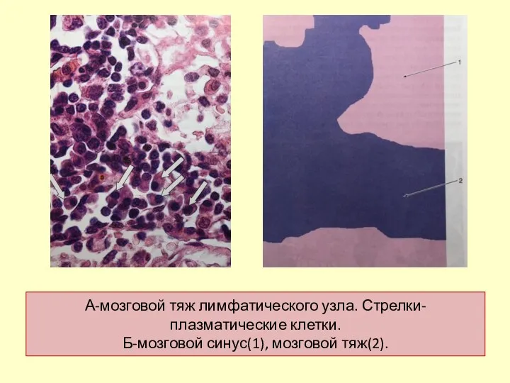 А-мозговой тяж лимфатического узла. Стрелки-плазматические клетки. Б-мозговой синус(1), мозговой тяж(2).