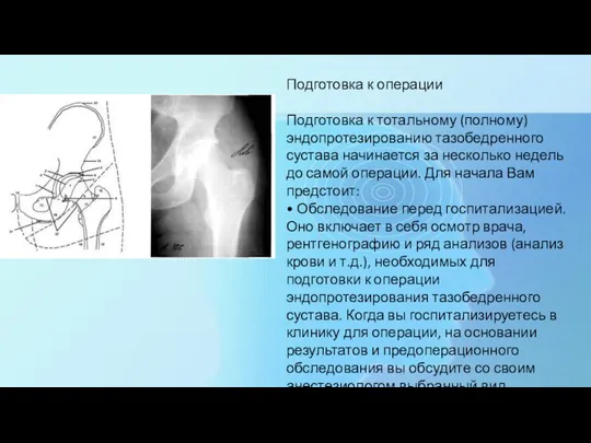 Подготовка к операции Подготовка к тотальному (полному) эндопротезированию тазобедренного сустава