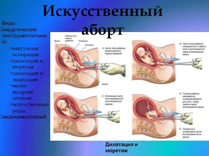Искусственный аборт Виды: хирургический (инструментальный) вакуумная аспирация дилатация и кюретаж