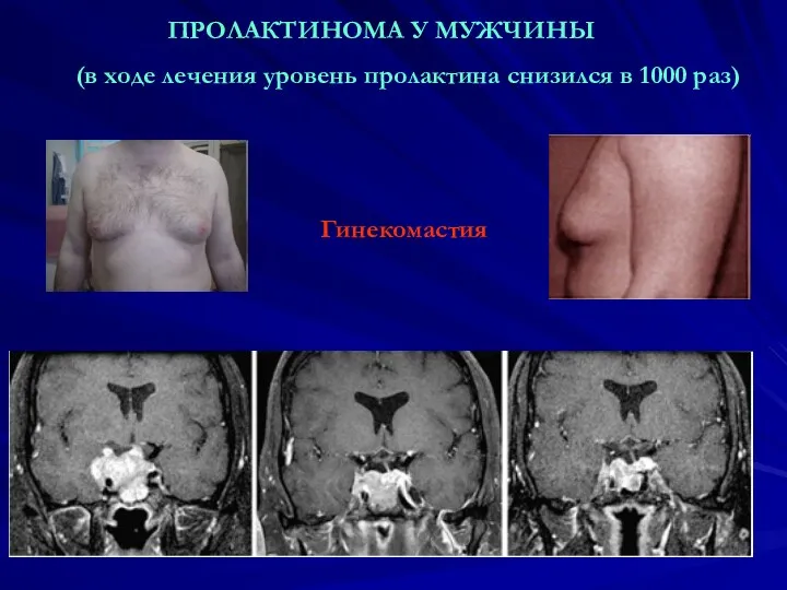 ПРОЛАКТИНОМА У МУЖЧИНЫ (в ходе лечения уровень пролактина снизился в 1000 раз) Гинекомастия