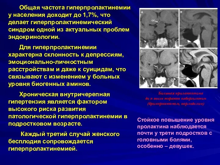 Большая пролактинома до и после терапии каберголином (бромкриптином, парлоделом) Общая