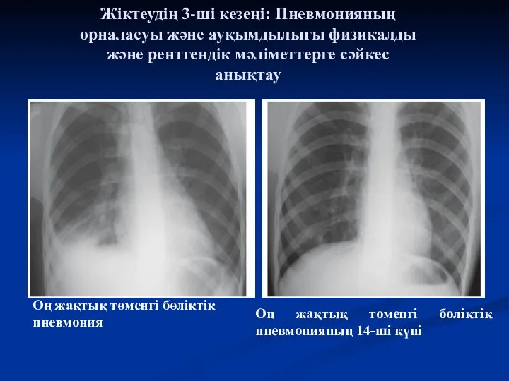Жіктеудің 3-ші кезеңі: Пневмонияның орналасуы және ауқымдылығы физикалды және рентгендік
