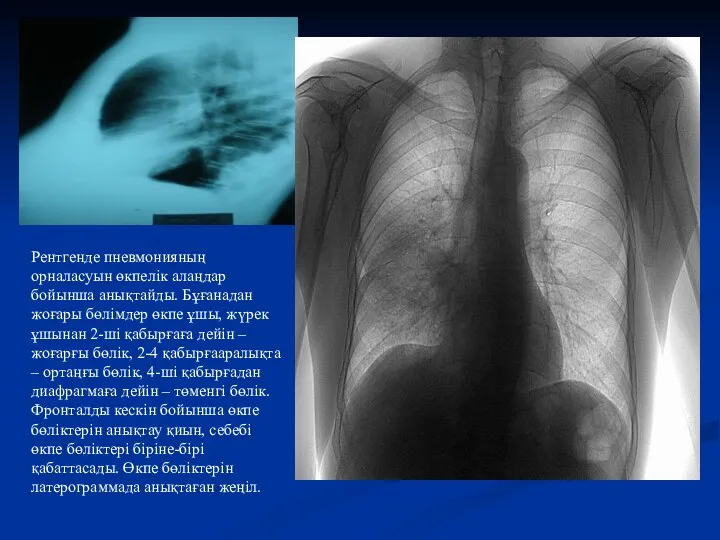 Рентгенде пневмонияның орналасуын өкпелік алаңдар бойынша анықтайды. Бұғанадан жоғары бөлімдер