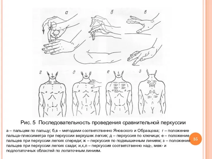 Рис. 5 Последовательность проведения сравнительной перкуссии а – пальцем по