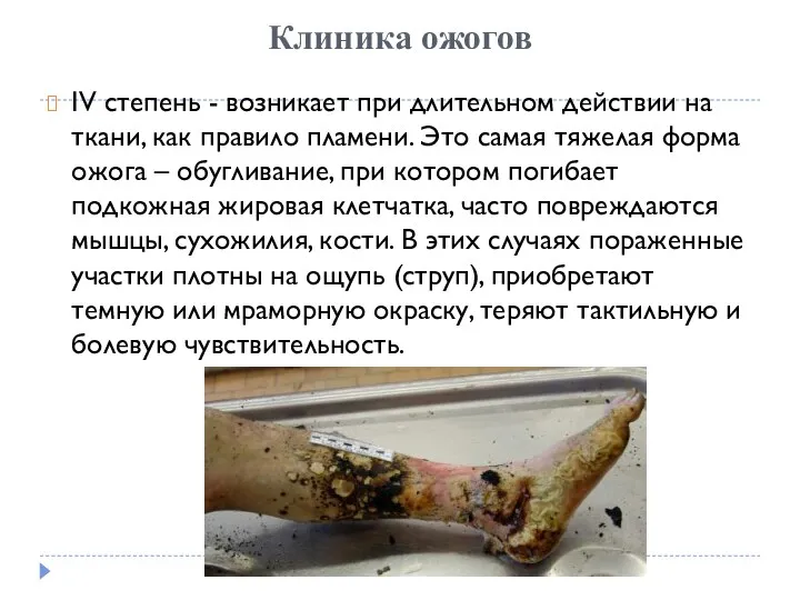 Клиника ожогов IV степень - возникает при длительном действии на