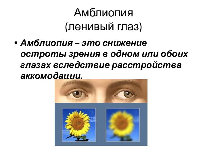 Амблиопия (ленивый глаз) Амблиопия – это снижение остроты зрения в