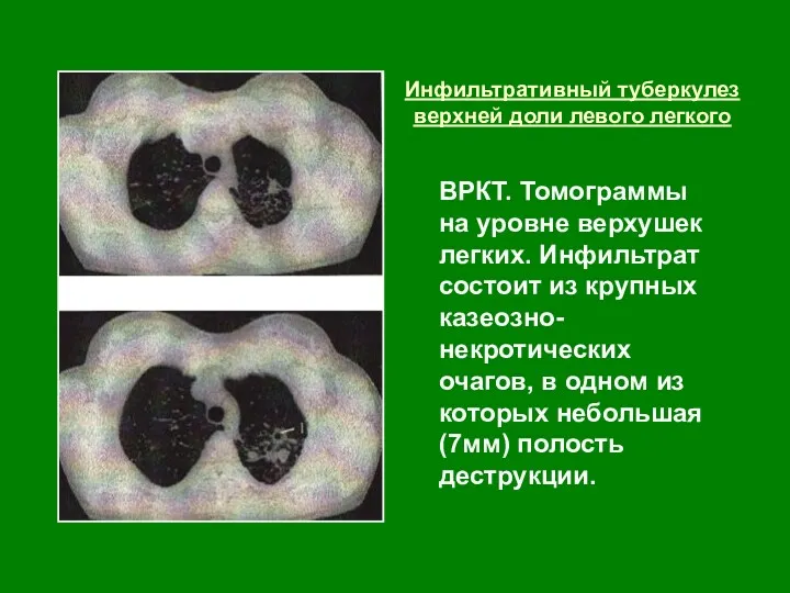 Инфильтративный туберкулез верхней доли левого легкого ВРКТ. Томограммы на уровне верхушек легких. Инфильтрат