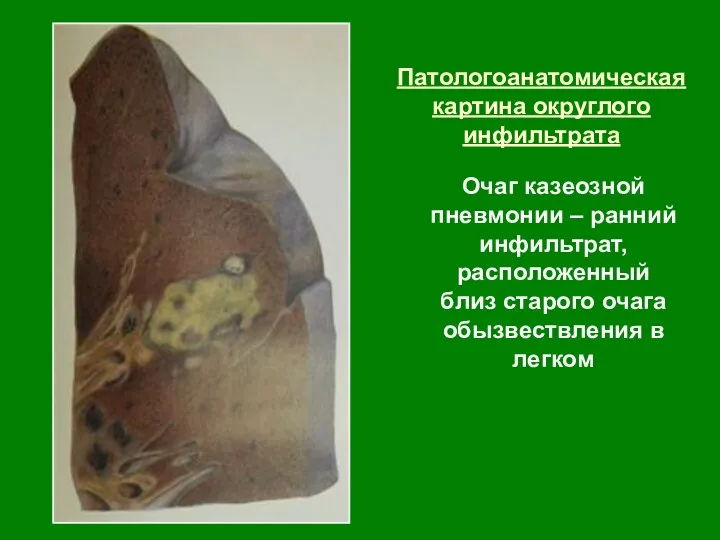Патологоанатомическая картина округлого инфильтрата Очаг казеозной пневмонии – ранний инфильтрат, расположенный близ старого