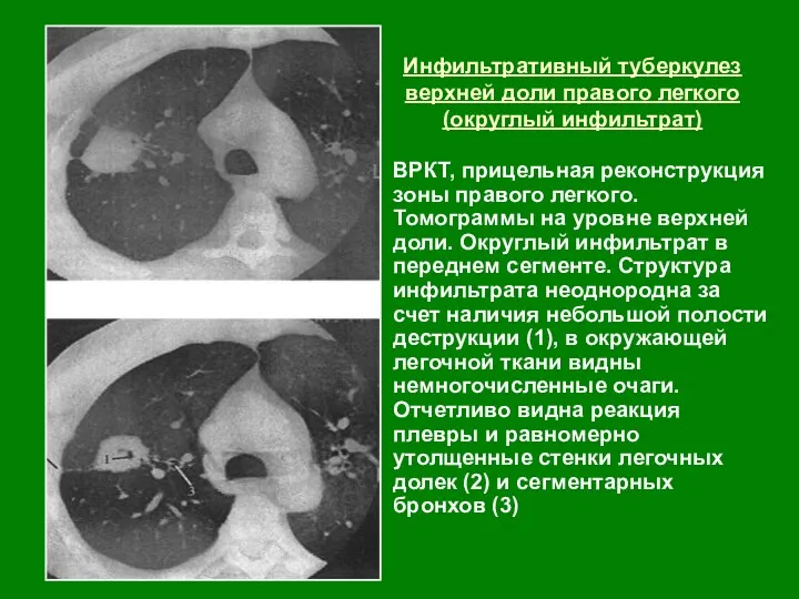 Инфильтративный туберкулез верхней доли правого легкого (округлый инфильтрат) ВРКТ, прицельная