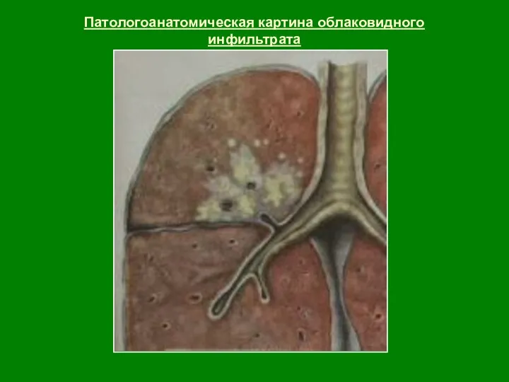 Патологоанатомическая картина облаковидного инфильтрата