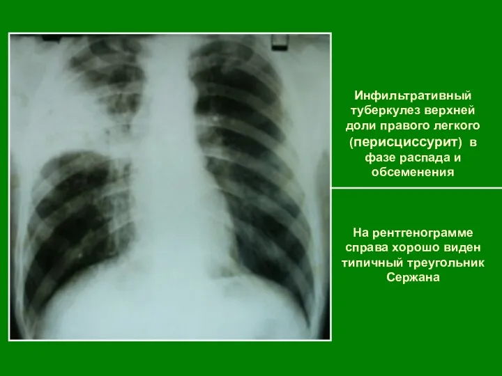 Инфильтративный туберкулез верхней доли правого легкого (перисциссурит) в фазе распада и обсеменения На
