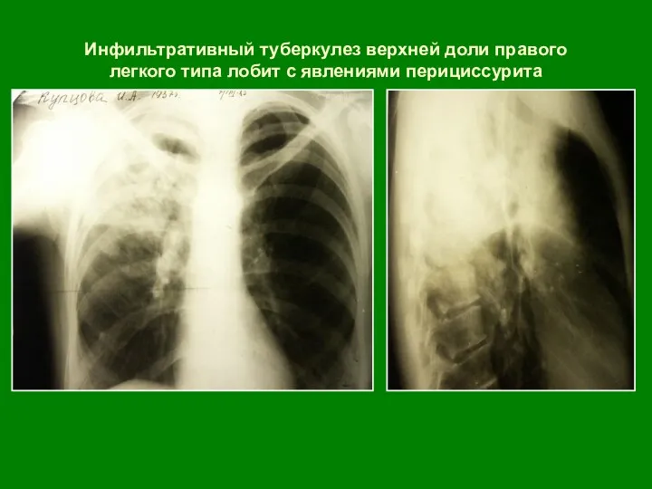 Инфильтративный туберкулез верхней доли правого легкого типа лобит с явлениями перициссурита