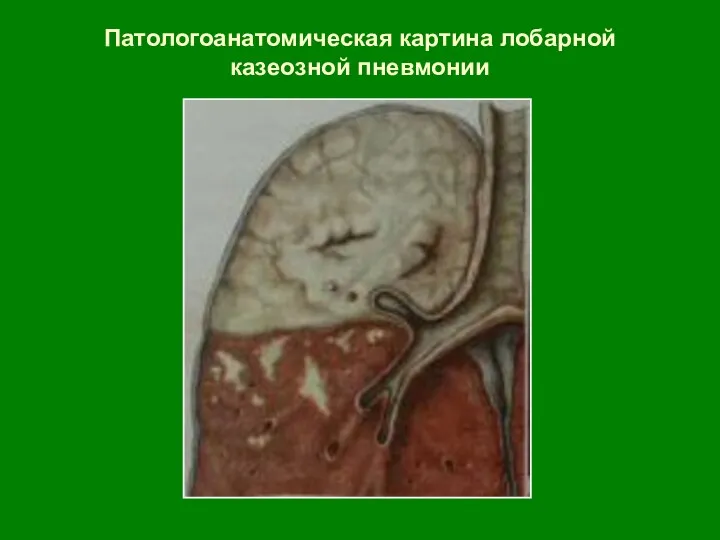 Патологоанатомическая картина лобарной казеозной пневмонии