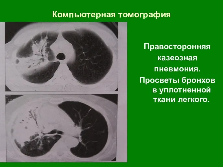 Компьютерная томография Правосторонняя казеозная пневмония. Просветы бронхов в уплотненной ткани легкого.