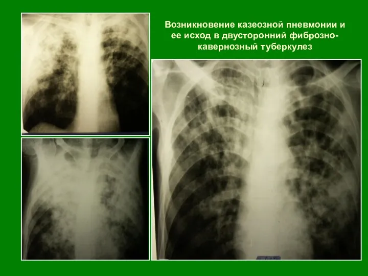 Возникновение казеозной пневмонии и ее исход в двусторонний фиброзно-кавернозный туберкулез