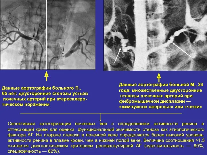 Данные аортографии больного П., 65 лет: двусторонние стенозы устьев почечных