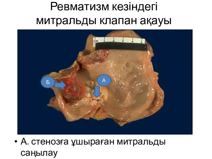 Ревматизм кезіндегі митральды клапан ақауы А. стенозға ұшыраған митральды саңылау Б. жүрекше аралық тромб А Б