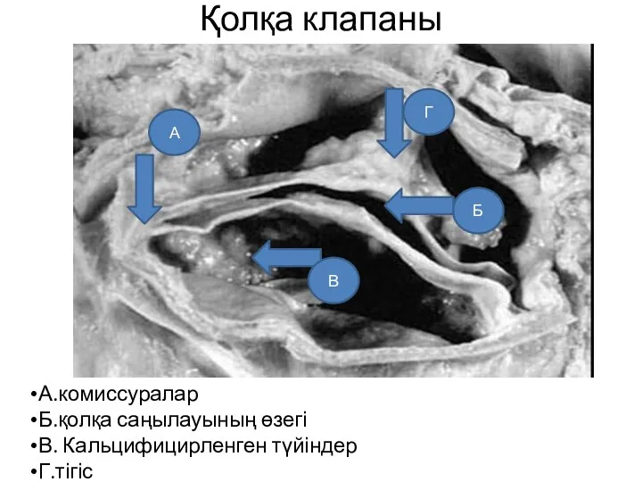 Қолқа клапаны А.комиссуралар Б.қолқа саңылауының өзегі В. Кальцифицирленген түйіндер Г.тігіс А Б В Г