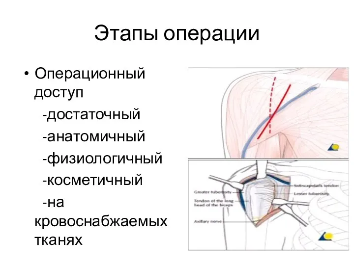 Этапы операции Операционный доступ -достаточный -анатомичный -физиологичный -косметичный -на кровоснабжаемых тканях