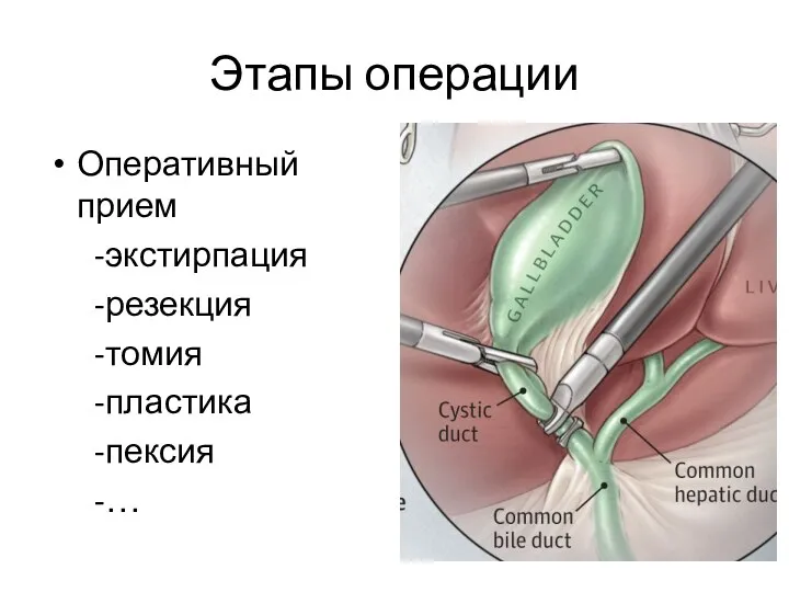 Этапы операции Оперативный прием -экстирпация -резекция -томия -пластика -пексия -…