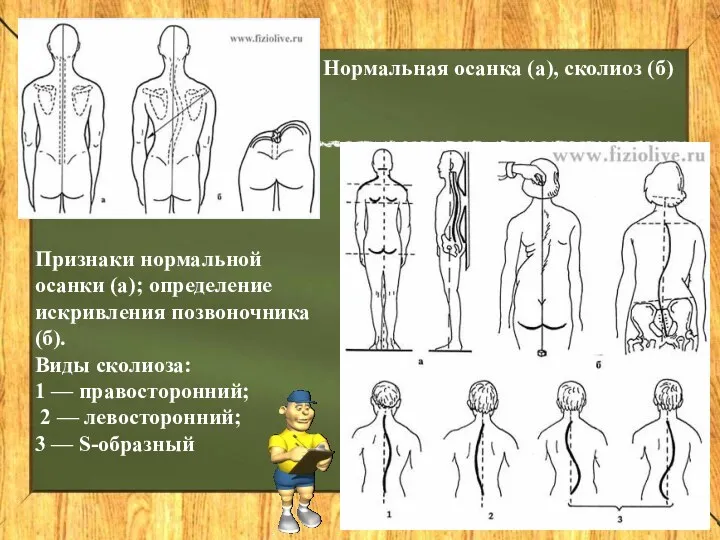 Нормальная осанка (а), сколиоз (б) Признаки нормальной осанки (а); определение