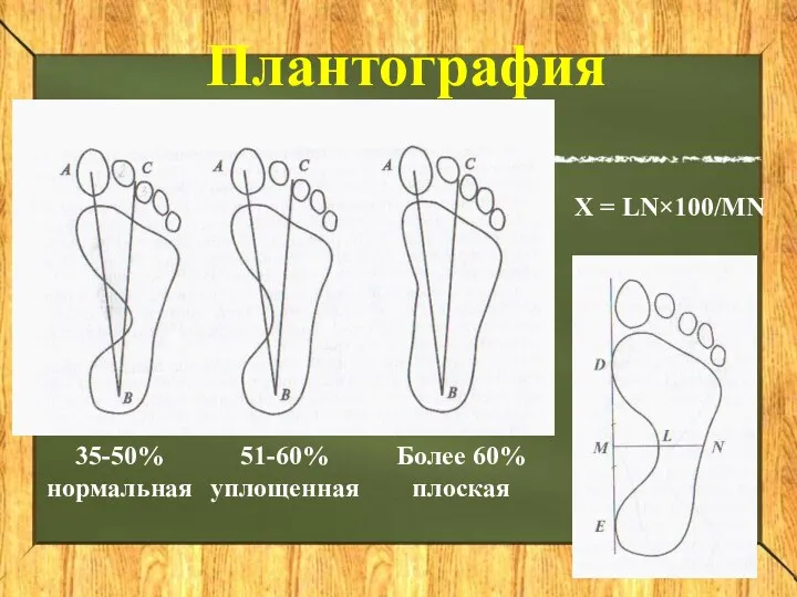 Плантография 35-50% нормальная 51-60% уплощенная Более 60% плоская Х = LN×100/MN