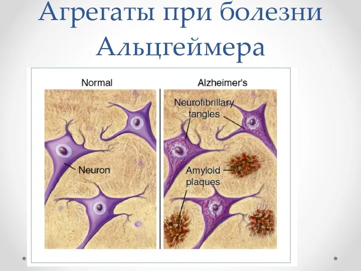 Агрегаты при болезни Альцгеймера