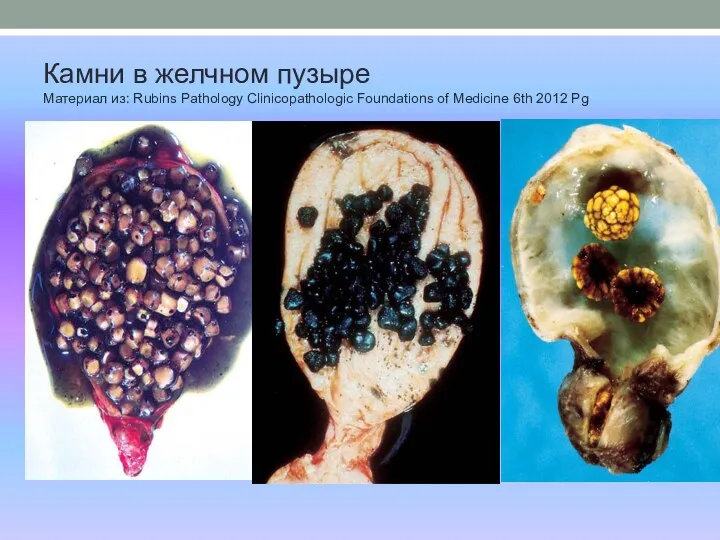 Камни в желчном пузыре Материал из: Rubins Pathology Clinicopathologic Foundations of Medicine 6th 2012 Pg