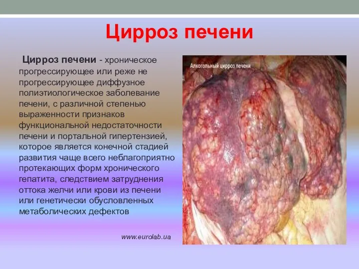 Цирроз печени Цирроз печени - хроническое прогрессирующее или реже не