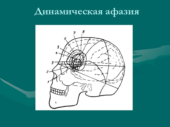 Динамическая афазия