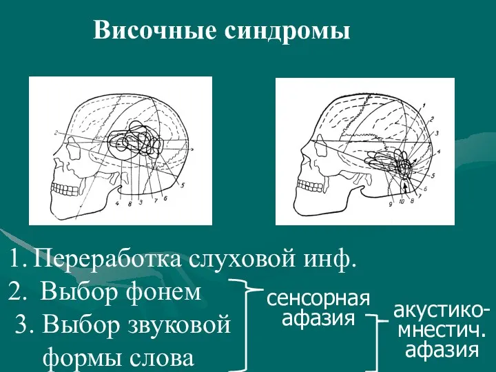 Височные синдромы Переработка слуховой инф. Выбор фонем 3. Выбор звуковой