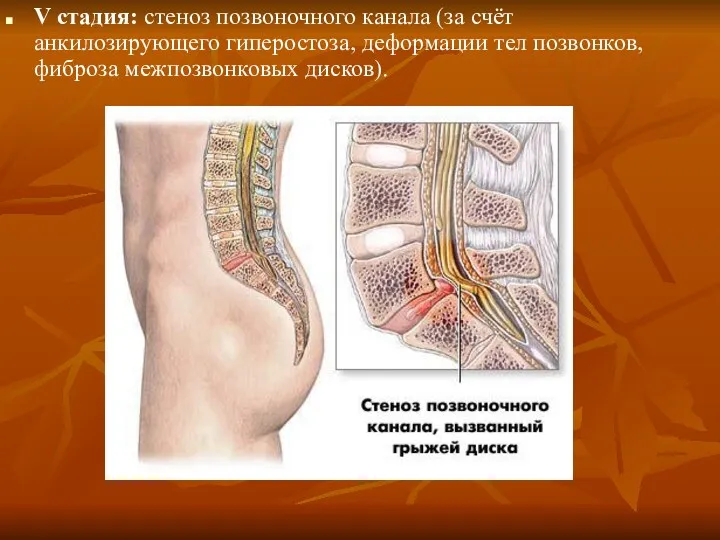 V стадия: стеноз позвоночного канала (за счёт анкилозирующего гиперостоза, деформации тел позвонков, фиброза межпозвонковых дисков).
