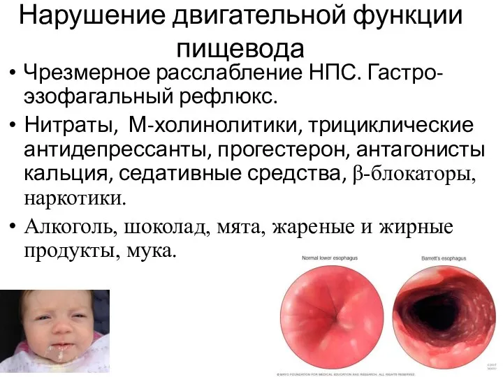 Нарушение двигательной функции пищевода Чрезмерное расслабление НПС. Гастро-эзофагальный рефлюкс. Нитраты,