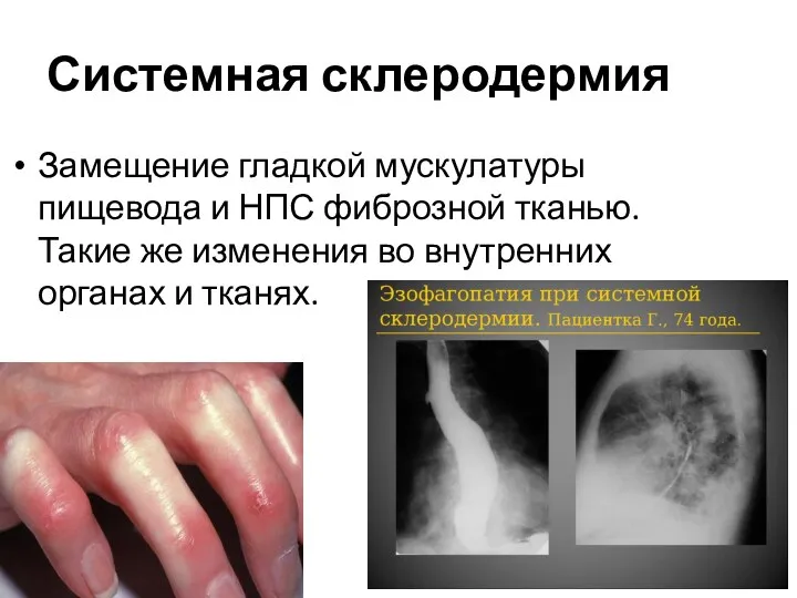 Системная склеродермия Замещение гладкой мускулатуры пищевода и НПС фиброзной тканью.