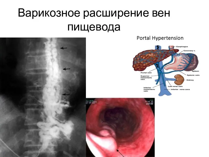 Варикозное расширение вен пищевода